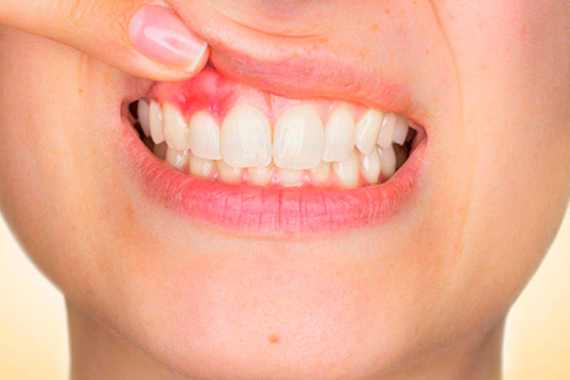 Foto da boca de uma mulher, com foco nos dentes e em uma área vermelha na gengiva.