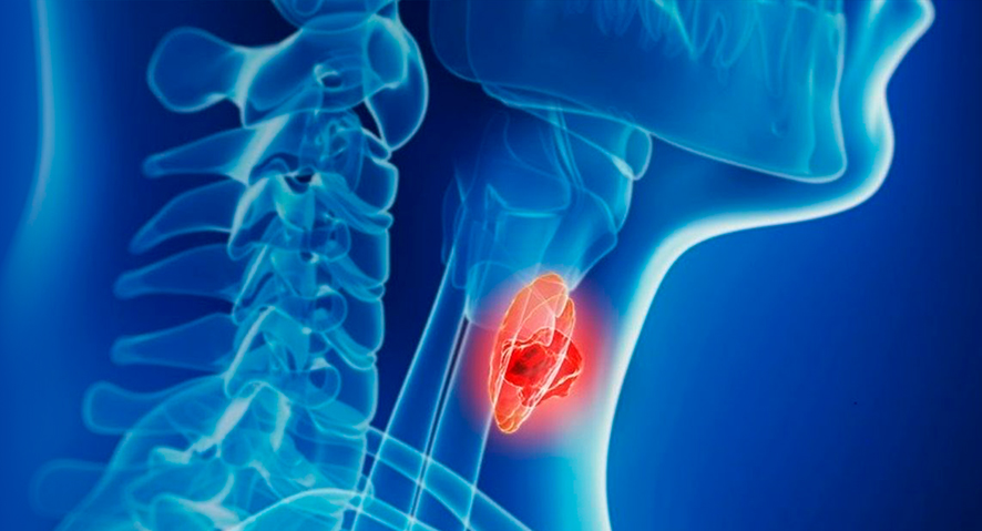 Ilustração de um pescoço células vermelhas indicando um linfoma