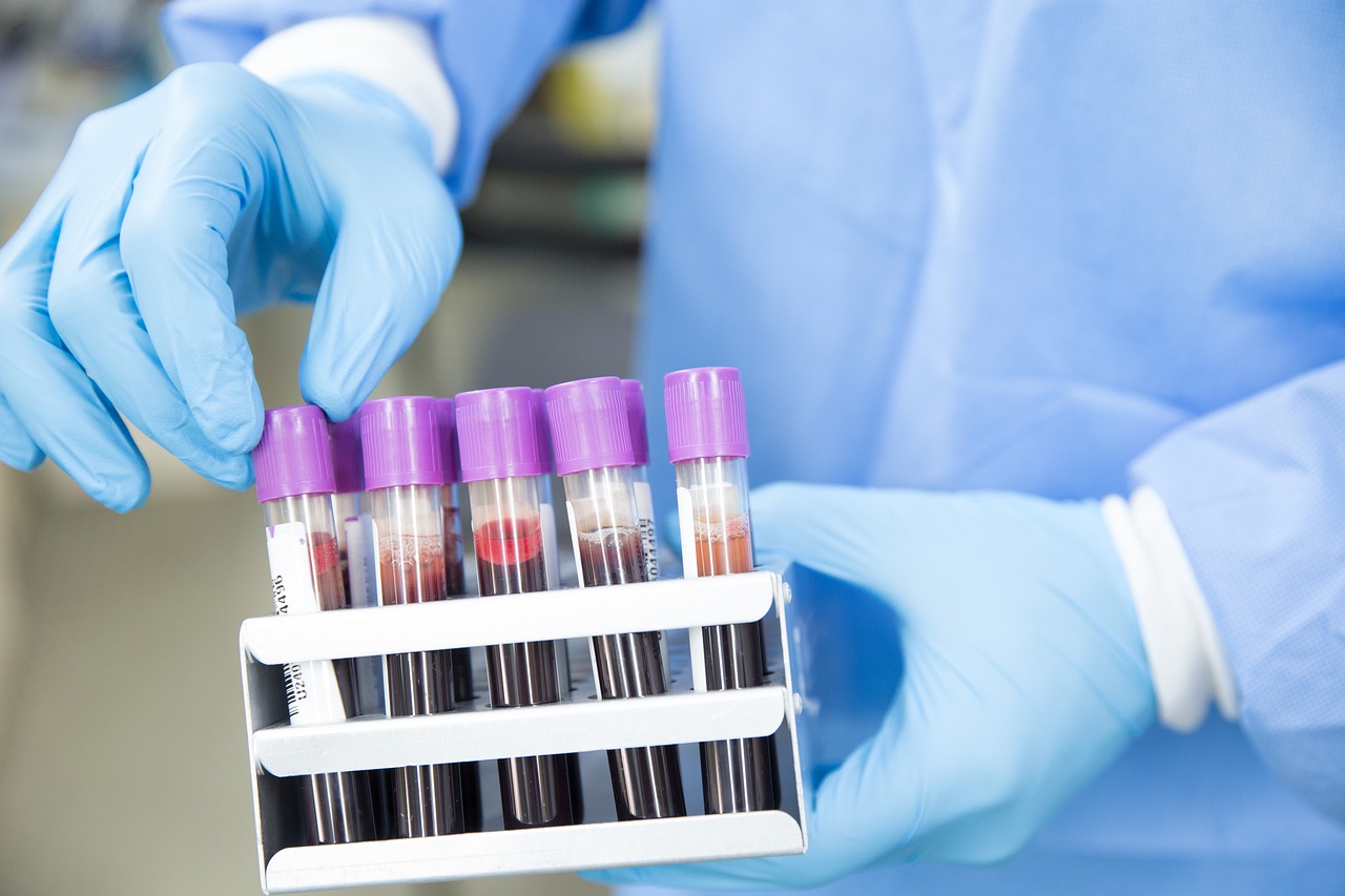 Foto de amostra de sangue. Um par de mãos usando luvas azuis está segurando uma caixa com cinco fileiras de tubos transparentes cheios de sangue, com tampas na cor lilás.