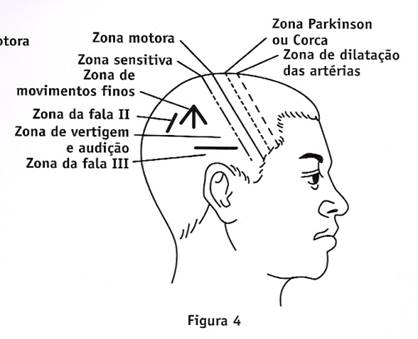 Ilustração de um crânio com as zonas de craniopuntura.